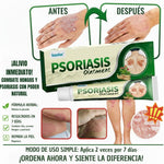 ⭐ PSORIASIS™ | Crema Antifúngica y Antipicazón (20g) ☀️