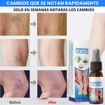 ✨ VARICOSE VEINS™ | Alivio y Cuidado para las Várices 🦵🛡️